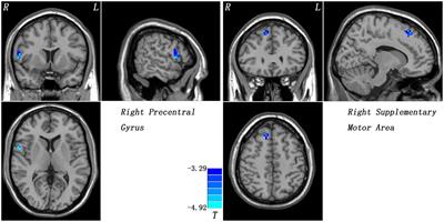 Reduced Global-Brain Functional Connectivity and Its Relationship With Symptomatic Severity in Cervical Dystonia